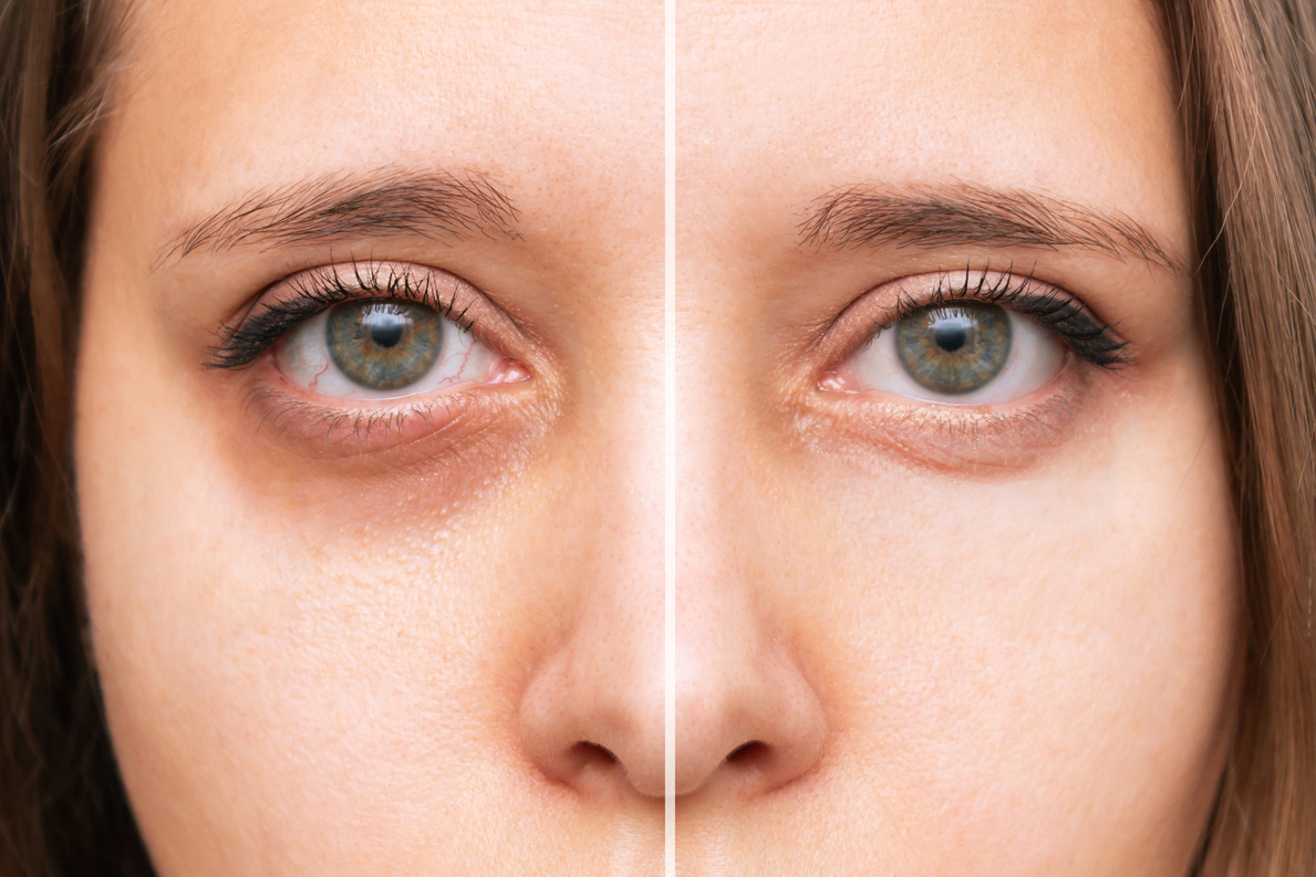 Close-up of female eyes with dark circles under eyes before and after cosmetic treatment Cosmetology